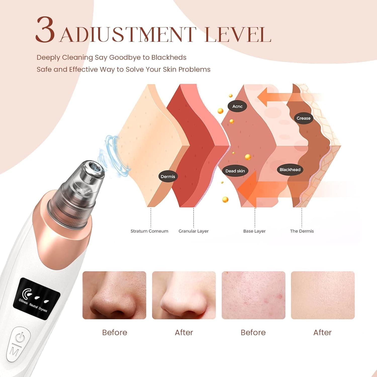 2025 Blackhead Remover Pore Vacuum Kit